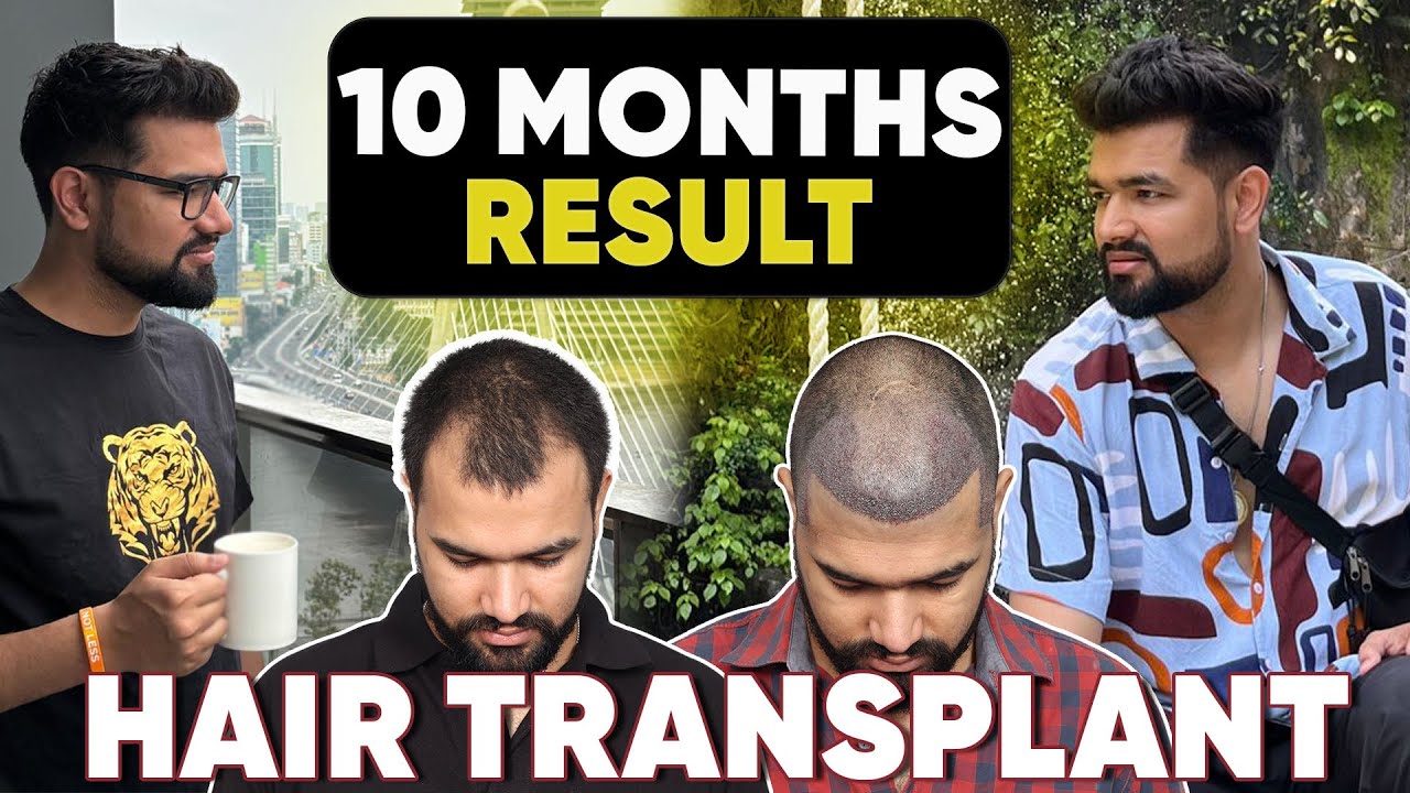 Hair Transplant in Delhi (HX-DPNV) | Best Results & Cost of Hair Transplant in Delhi