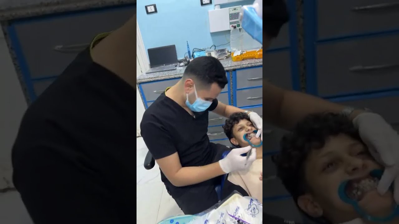 بث مباشر الان لحالة تقويم الاسنان للفك السفلي||Live broadcast now of the lower jaw orthodontics case
