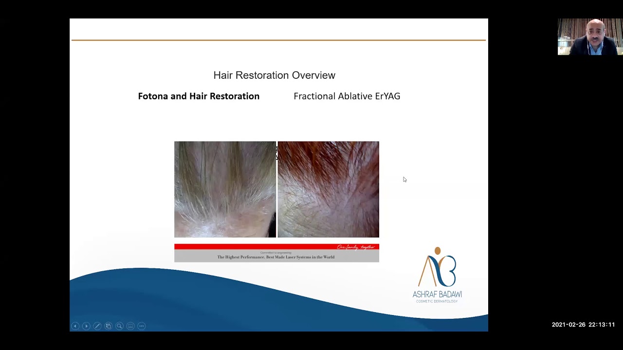 Prof. Ashraf Badawi talk about Laser assisted hair restoration Using the Fotona Er:YAG Laser System