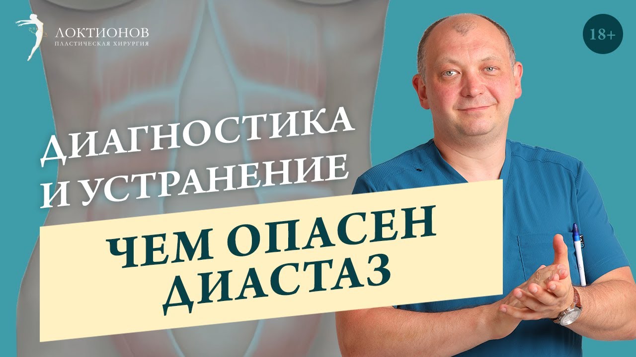 Что такое диастаз и нужно ли с ним бороться? // 18+