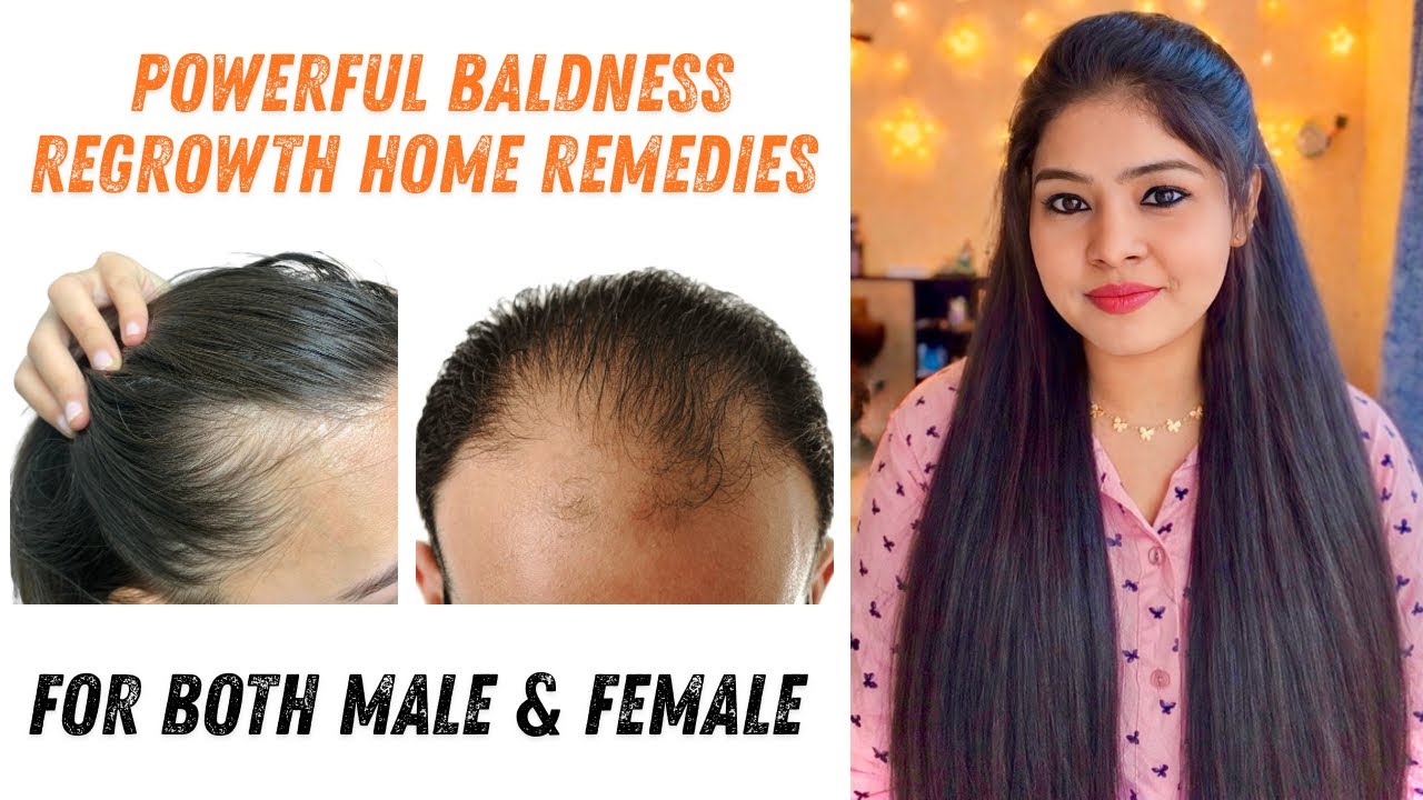 Magical Regrowth Remedies for Baldness and Hair Thinning 🪻Results from 4 weeks 💯Vini’s Hair Care ❤️