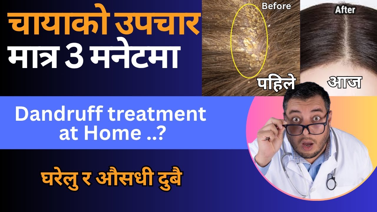 चायाको उपचार मात्र 3 मनेटमा  / chayako upachar  / Dandruff treatment at Home Mero Health