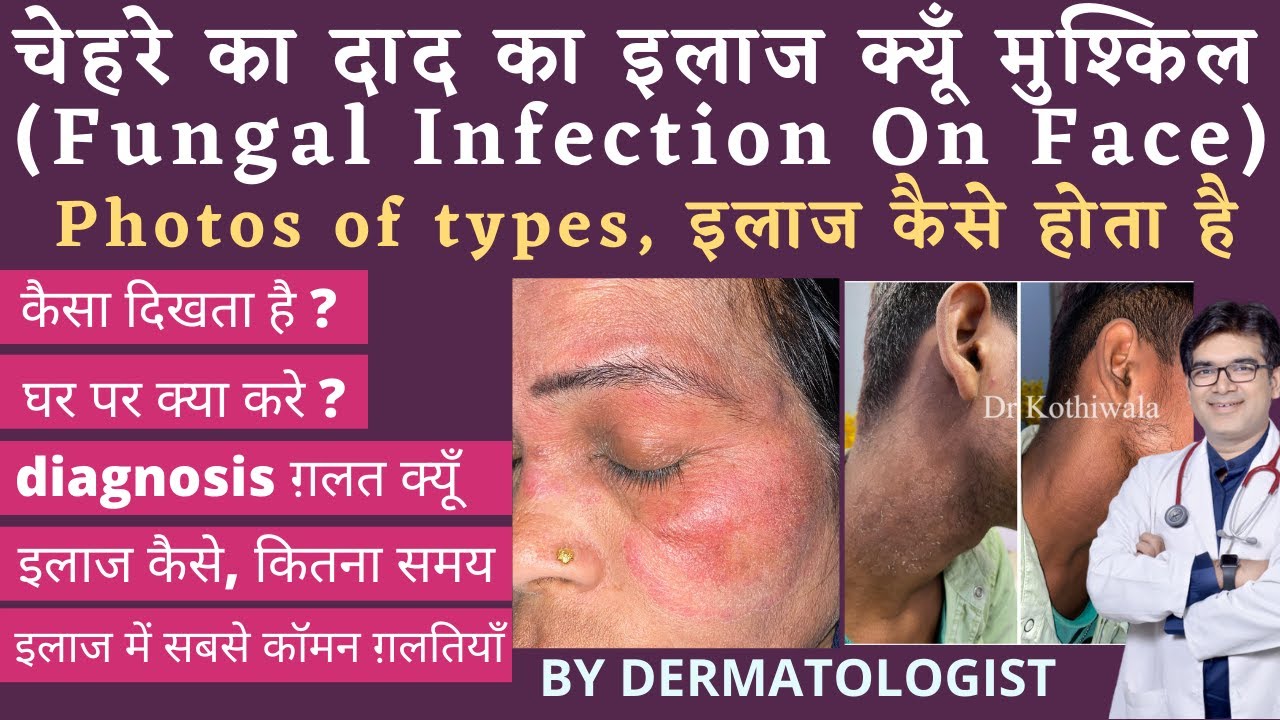 चेहरे के दाद का इलाज | Treatment of Fungal Infection On Face | 5 Important Facts Must Watch