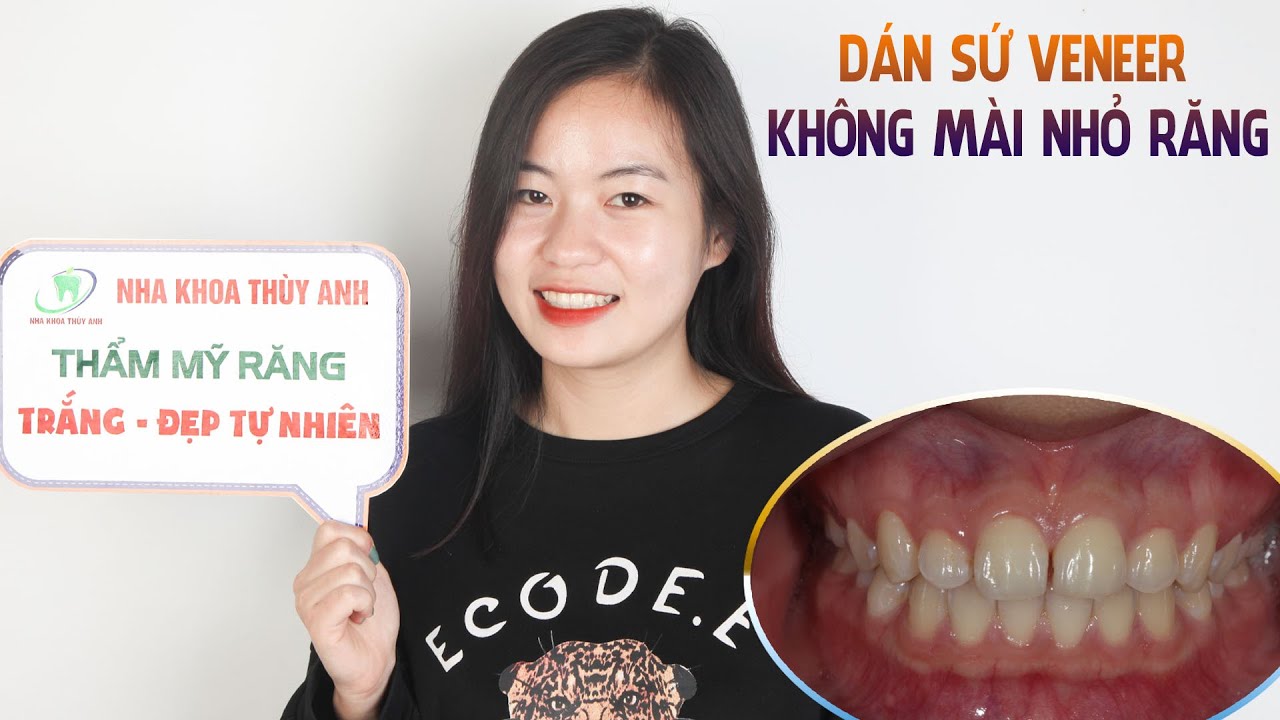 Dán sứ Veneer sửa khe thưa không mài nhỏ răng