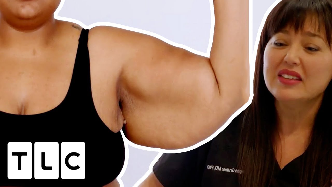 TWO Surgeries: GIANT Wingspan And A MISSING Jaw | Awake Surgery