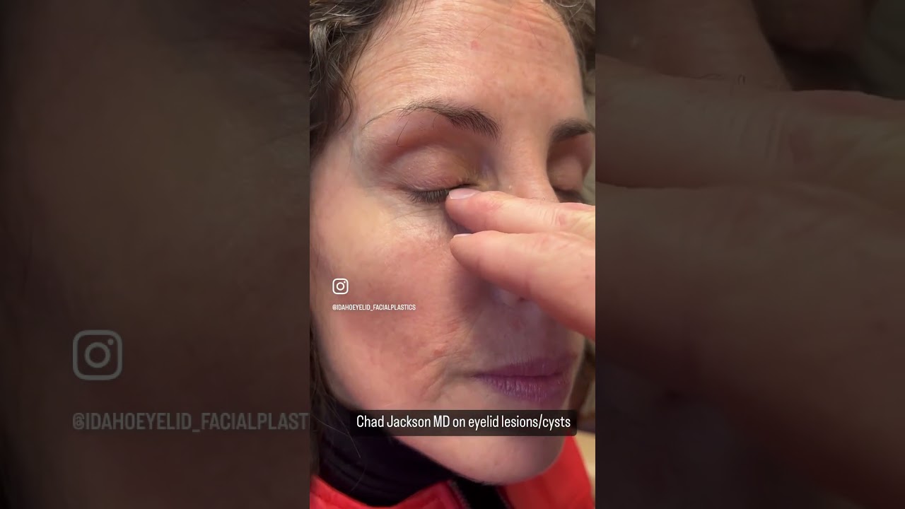 Eyelid bumps and lumps! To schedule call 208.344.3220