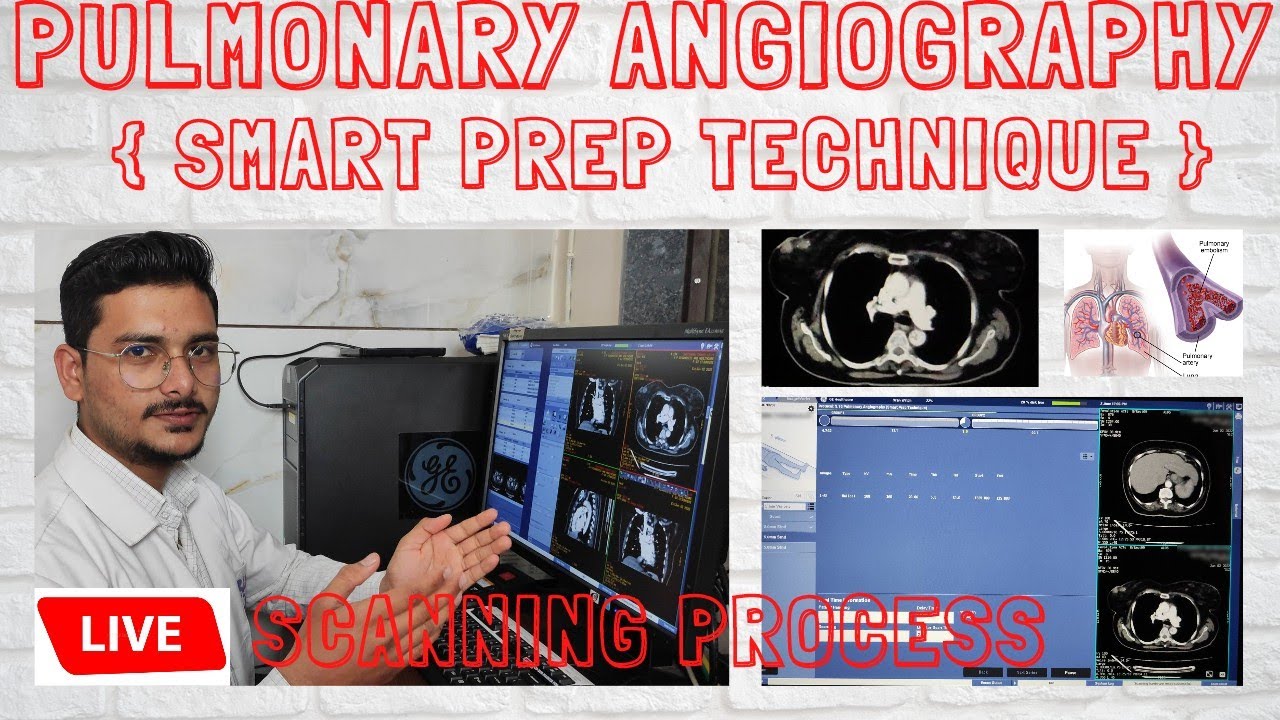 Pulmonary Angiography (smart prep technique) Live CT Scan | pulmonary angio scanning process