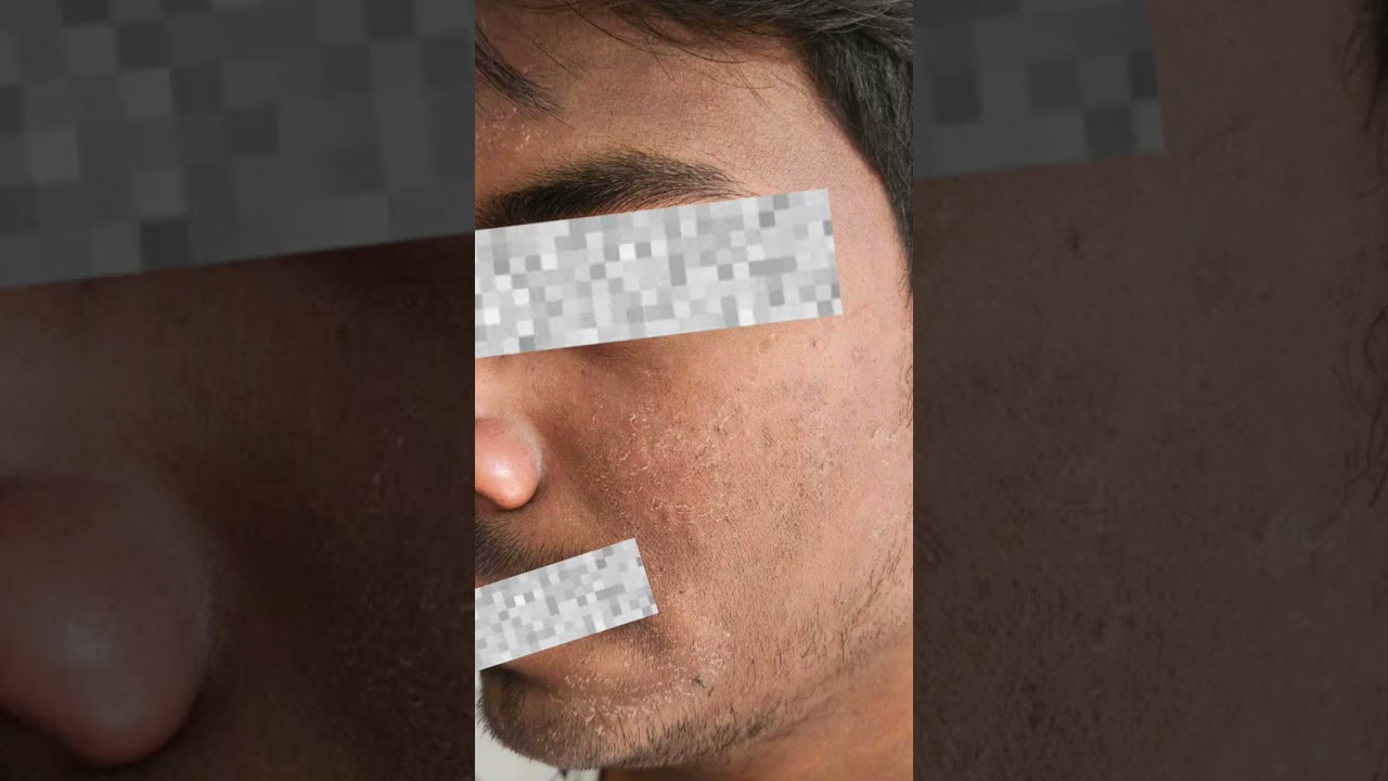 Skin peeling after treatment with yellow peel 