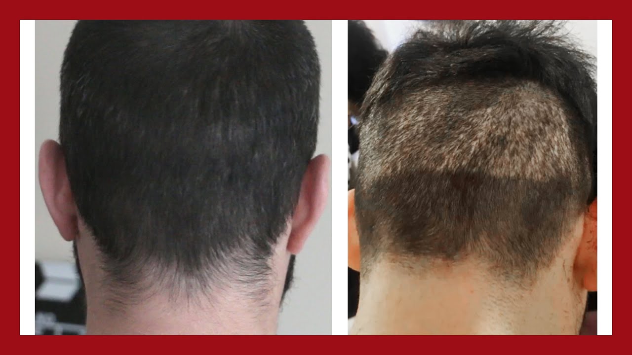 1 MOIS APR&Egrave;S : Attention &agrave; votre zone donneuse ! | MA 2&Egrave;ME GREFFE DE CHEVEUX