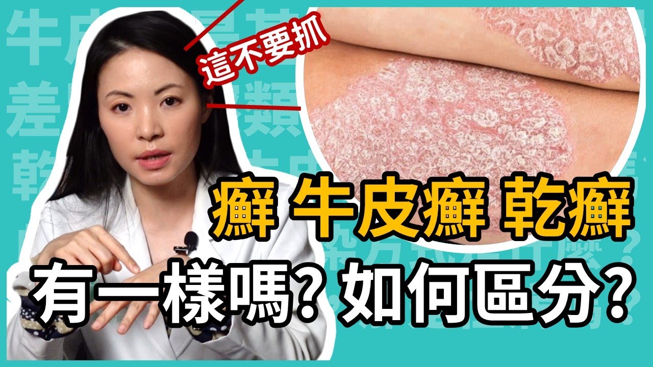 癬、乾癬、牛皮癬到底有什麼不一樣？乾、癢、紅腫就是癬嗎？皮膚科林昀萱醫師教你聰明辨識！