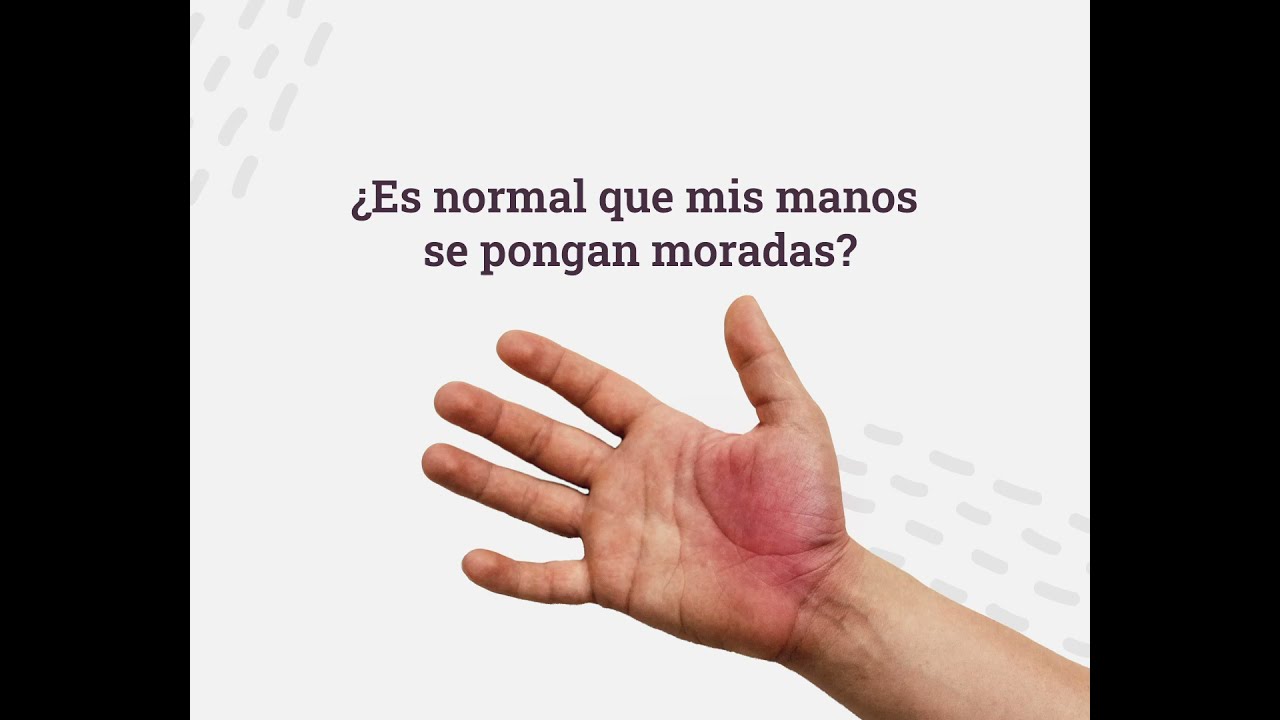 ¿Es normal que mis manos se pongan moradas?- Aclarando dudas.