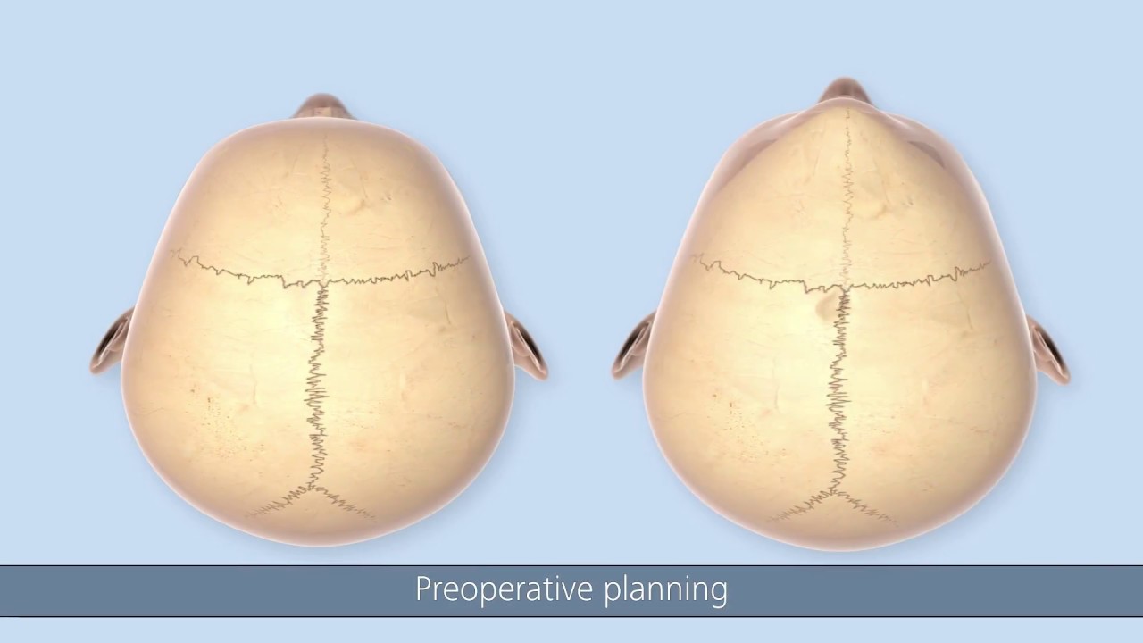 SonicWeld Rx&reg; Surgical Technique &ndash; Craniosynostosis