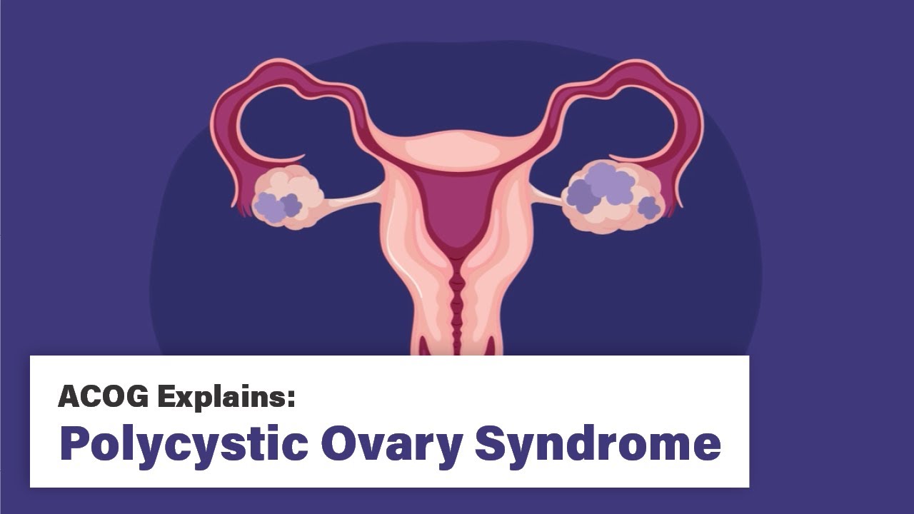 ACOG Explains: Polycystic Ovary Syndrome