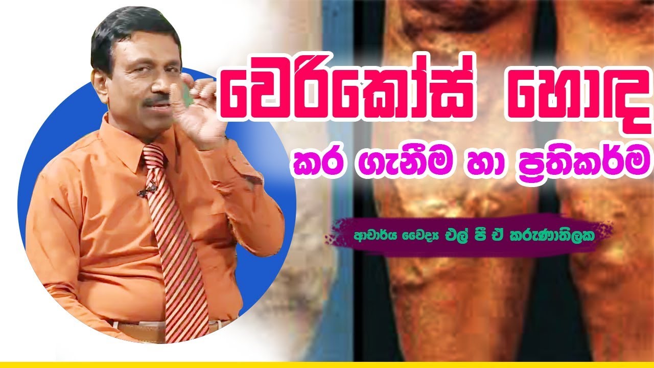 වෙරිකෝස් හොඳ කර ගැනීම හා ප්‍රතිකර්ම | Piyum Vila | 26 -08-2019 | Siyatha TV