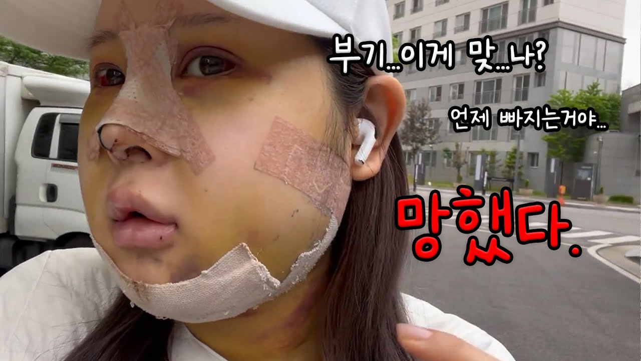 윤곽 수술 했는데 🐶망했다(찐 현실 주의 수술직후~한달차있음) [혜주Vlog]