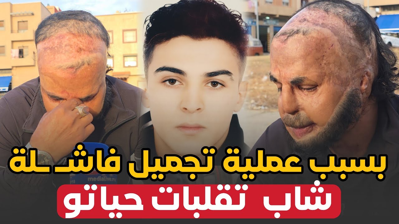 بسبب عملية تجميل فـ ـاشلة .. شاب إنقلـ ـبت حياته .. يكشف حقائق تسمع لاول مرة