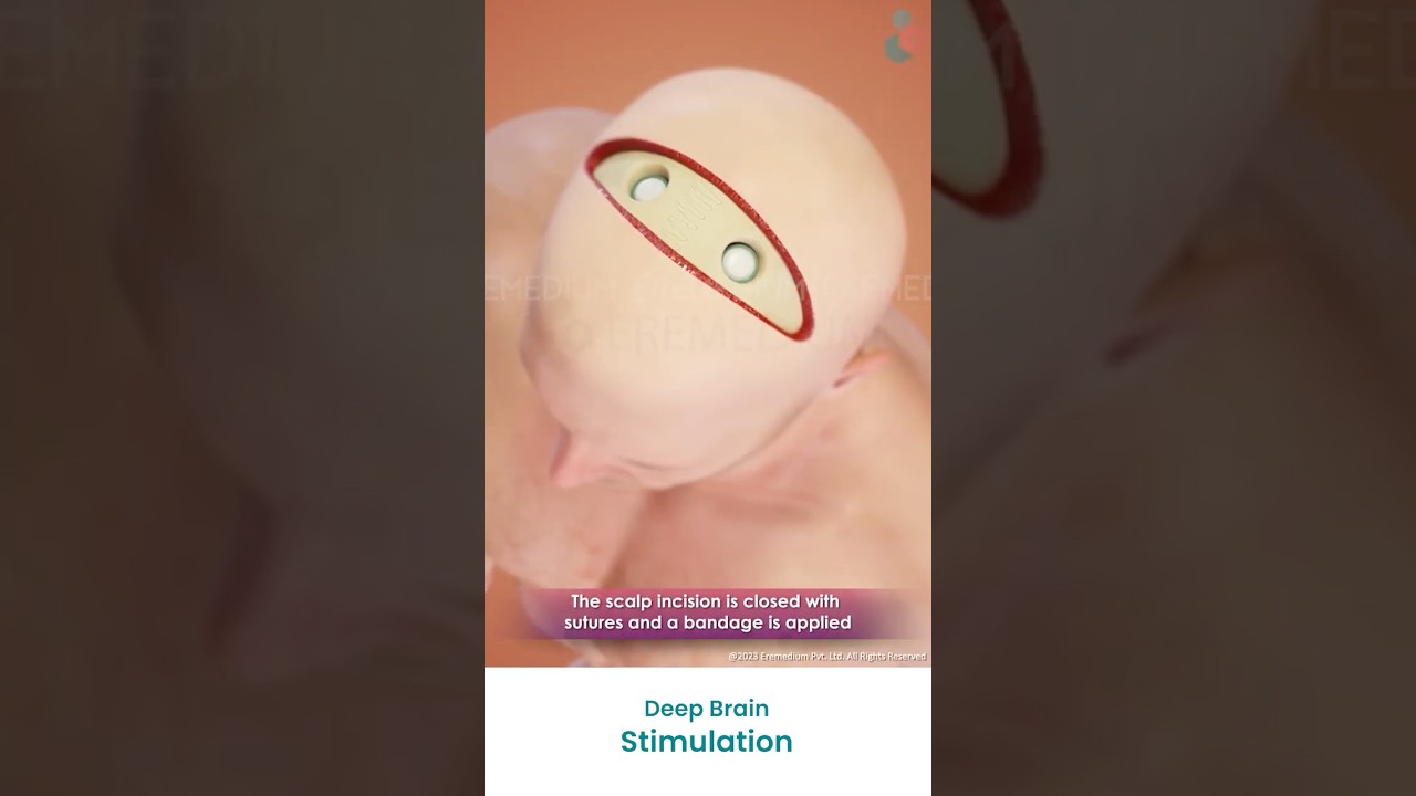 What is Deep Brain Stimulation (DBS)? ↪ 3D Medical Animations #(DBS)&nbsp;#DeepBrainStimulation&nbsp;#Shorts