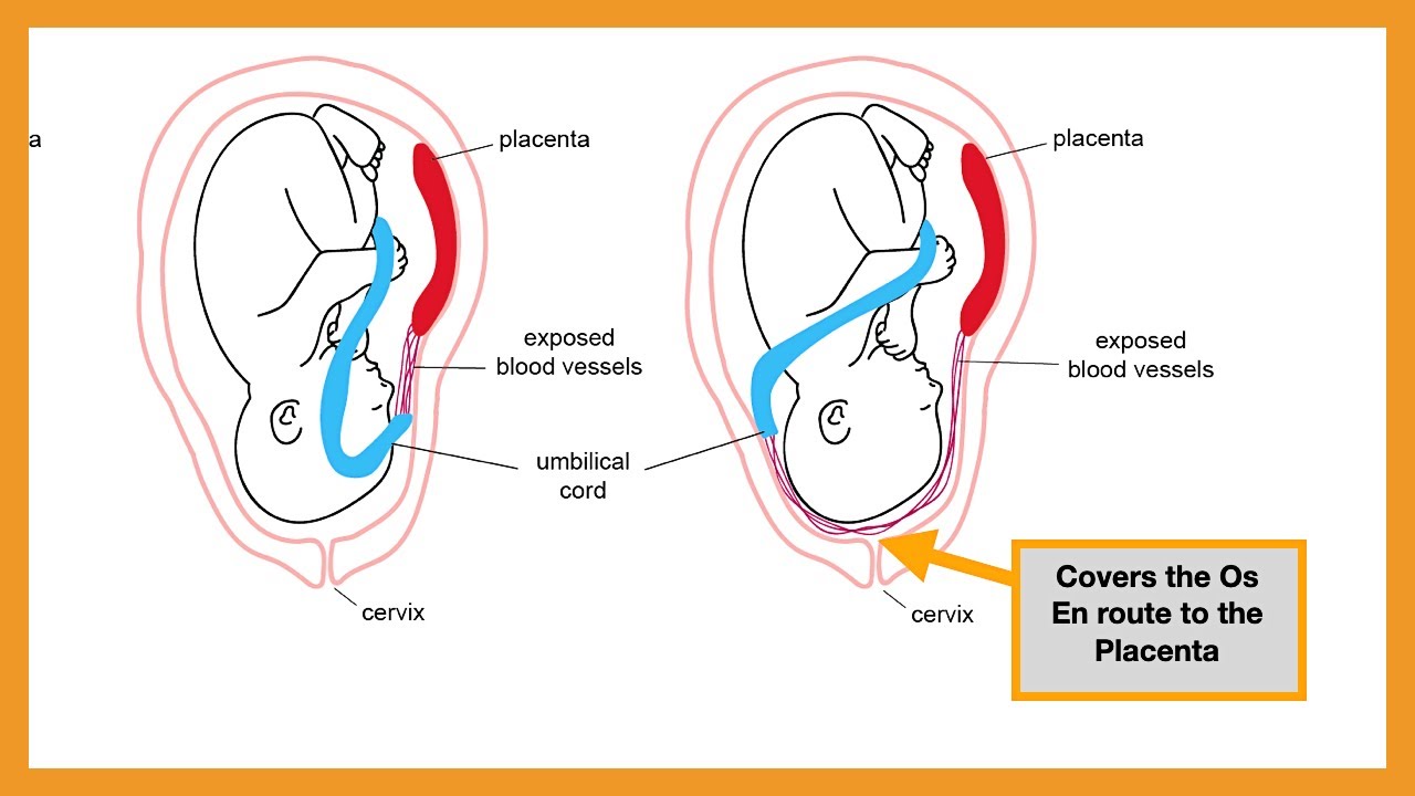 Placenta Pathology (Abruptio Placentae, Placenta Accreta/Increta/Percreta, Placenta/Vasa Previa)