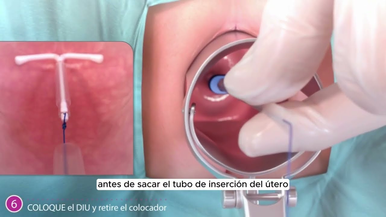 Inserción del DIU hormonal AVIBELA (Spanish)
