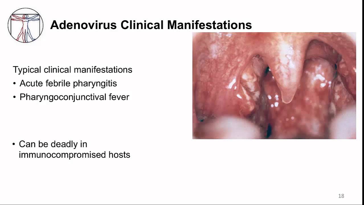 Respiratory Viruses: Upper Respiratory Tract