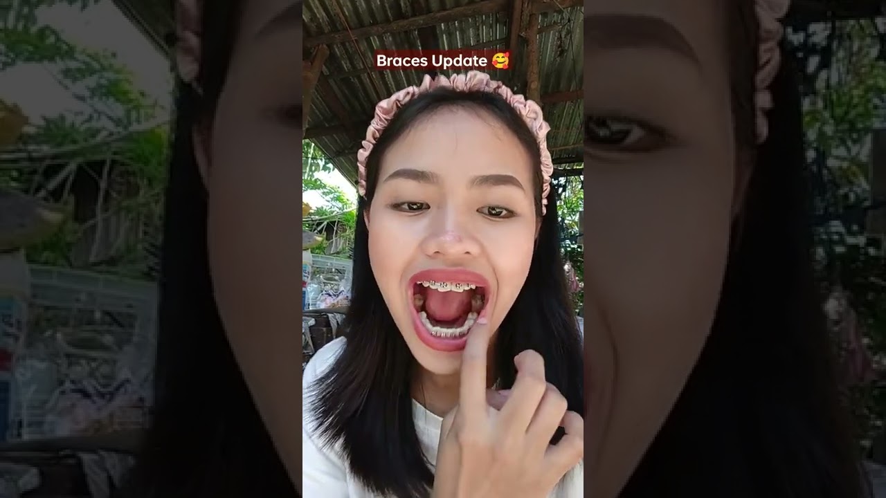 Braces Update (may kakaibang nilagay yung dentist ko)