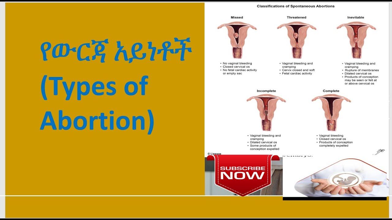 የውርጃ አይነቶች (Types of Abortion)