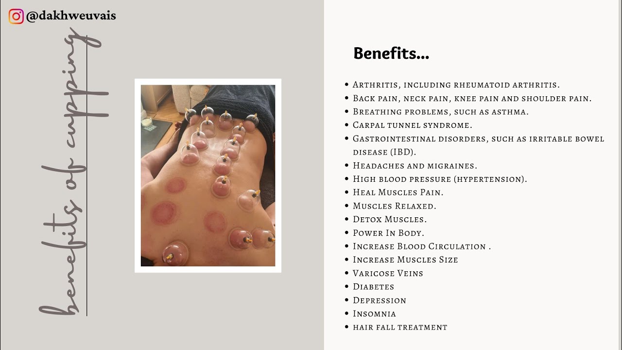 Hijama (Hijamah) The Cupping Therapy . #cupping #cuppingtherapy #mumbra #mumbratimes #hijama #thane