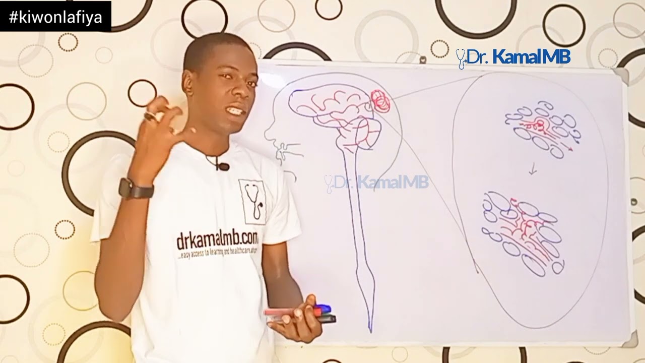 cutar Shanyewar barin jiki na fashewar jijiyar jini #drkamalmb #shanyewarbarinjiki #stroke #cuta