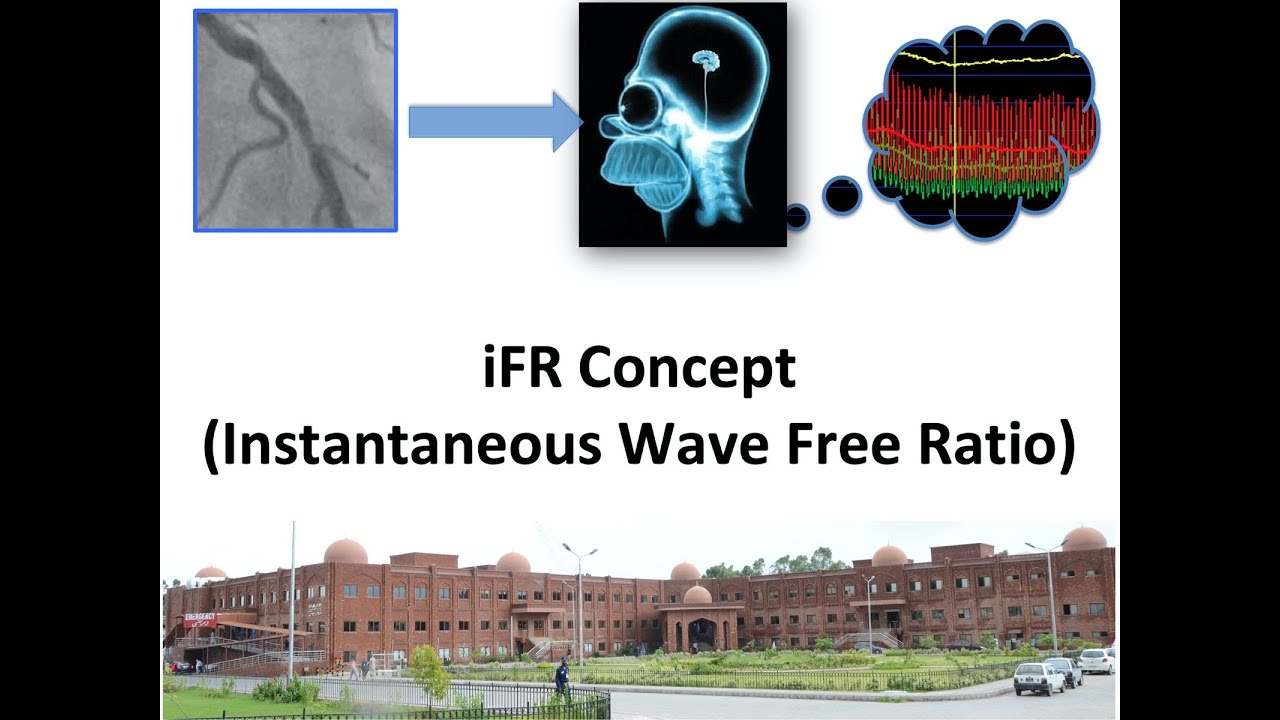 3 iFR Concept in Coronary Physiology (instantaneous Wave Free Ratio)
