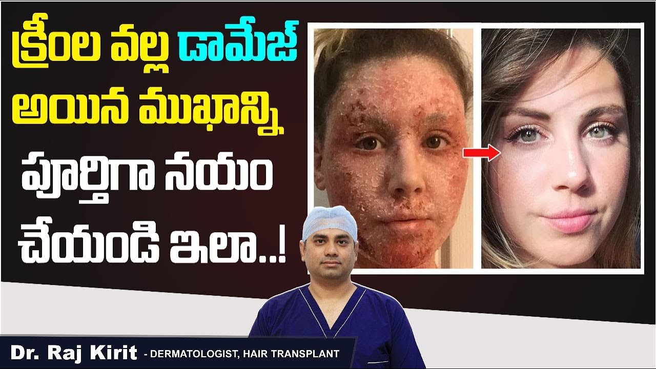 ముఖానికి ఈ క్రీంలు వాడితే || How to Recover From Steroid Cream Side Effects || Celestee Skin Clinic