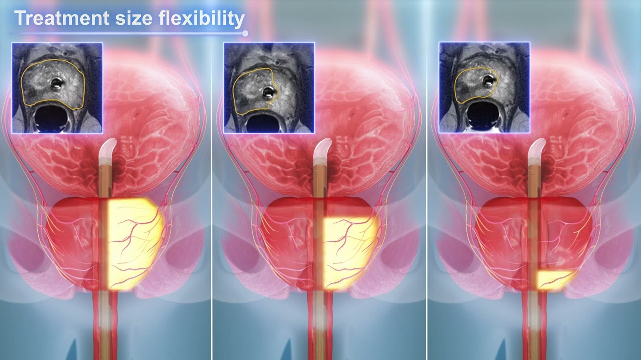 What is the TULSA-PRO |  | TULSA Procedure | Profound Medical