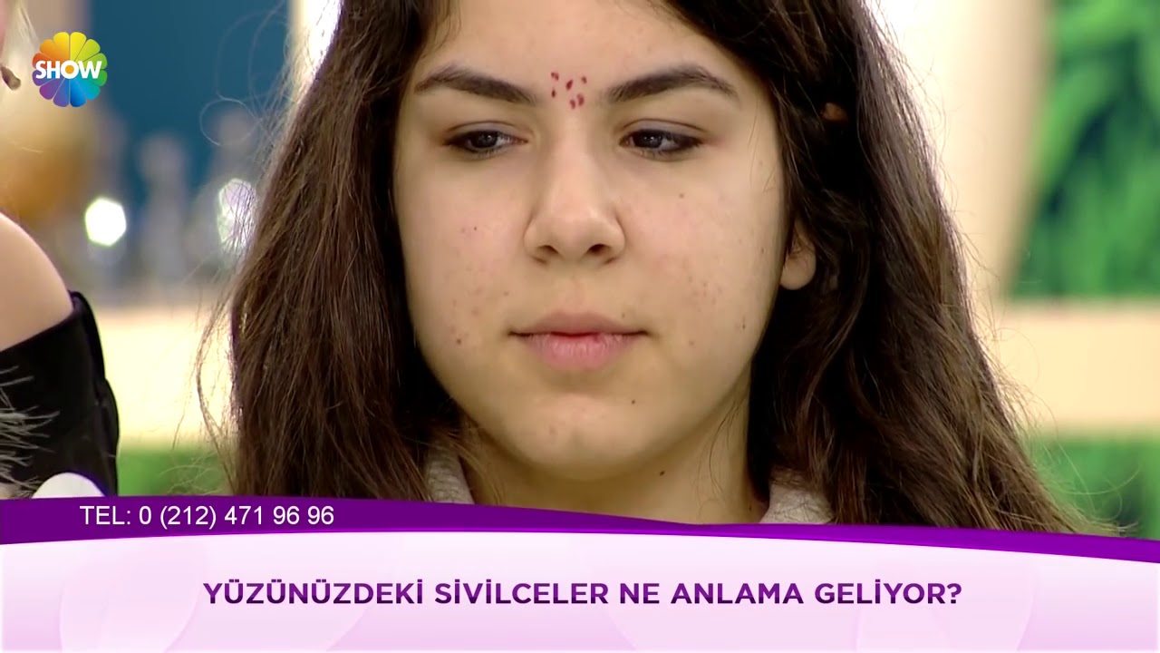 Yüzümüzdeki sivilceler ne anlama geliyor?