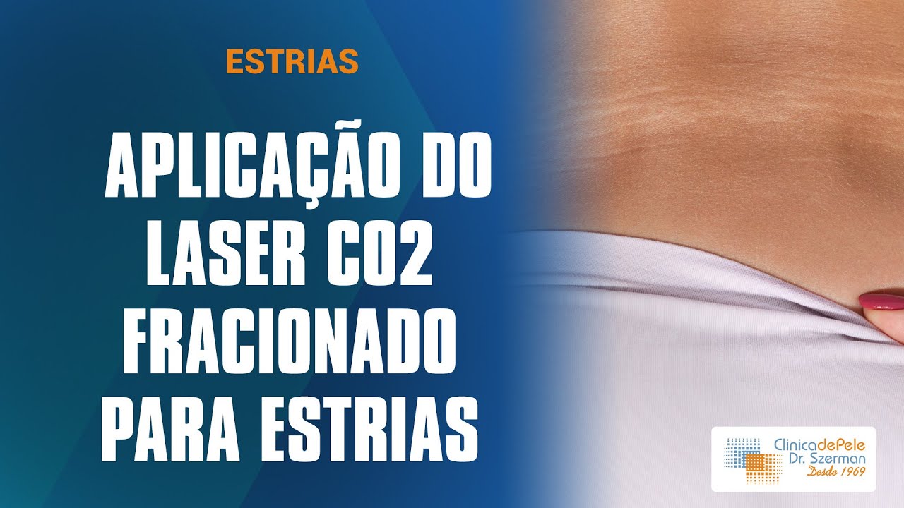 Estrias [Laser de Co2 Fracionado DEKA]