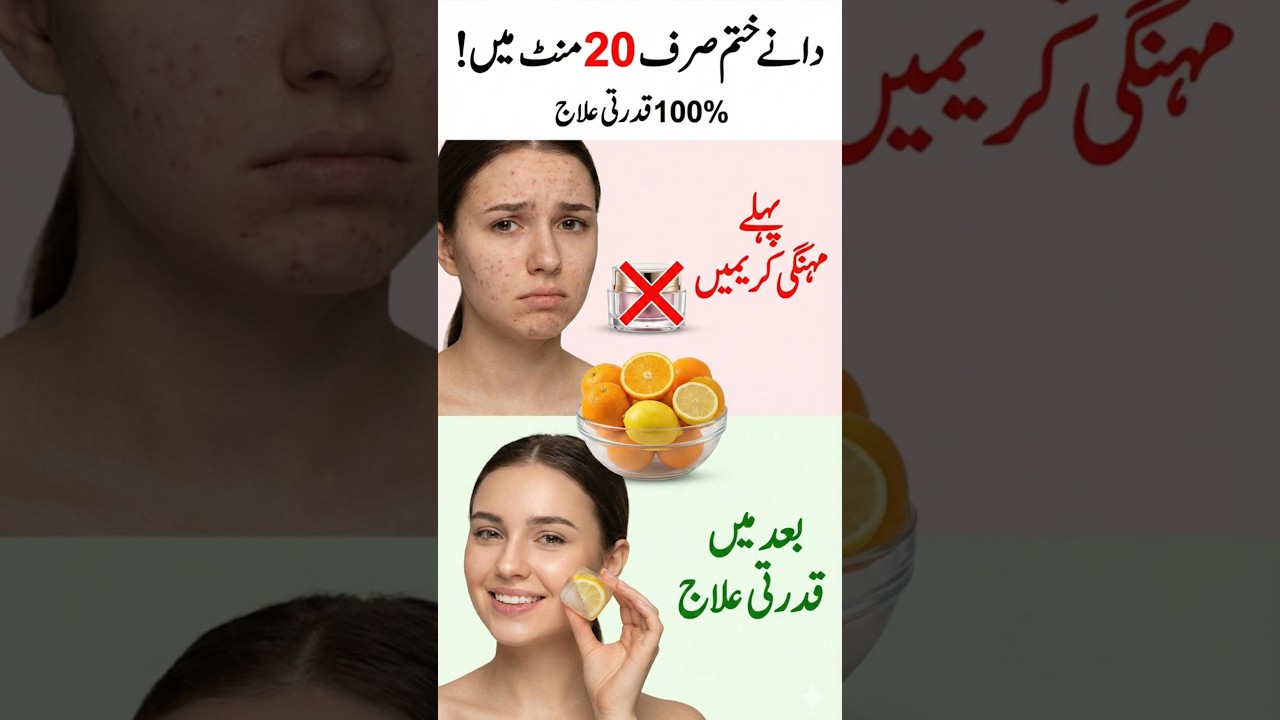 Pimples /Acne Remedy in 20 mins | Danay/Muhasay fori khatam | Desi Nuskhay