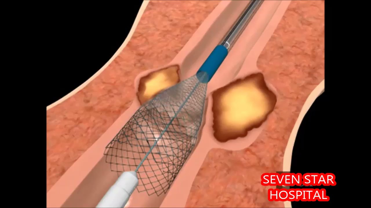Endoscopic Esophageal stenting