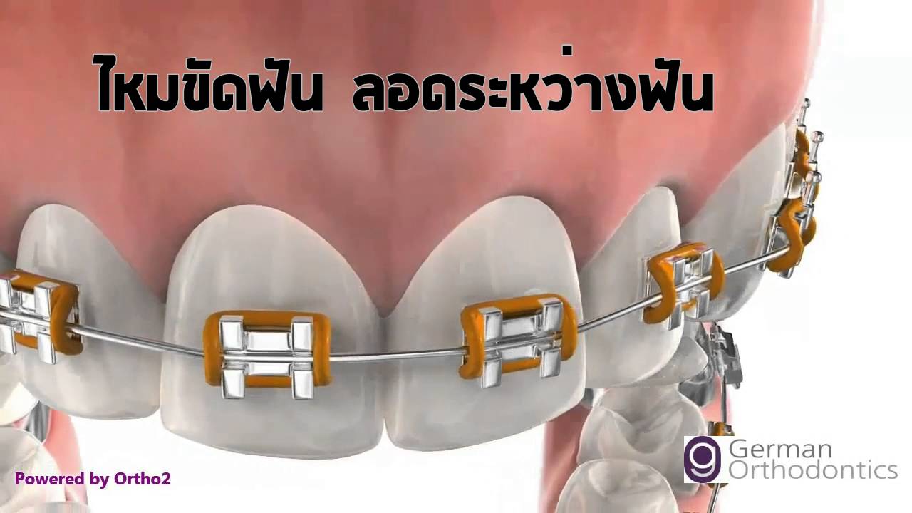 การดูแลฟันระหว่างจัดฟัน  พนัสนิคม ชลบุรี คลินิกทันตกรรมเอสซี