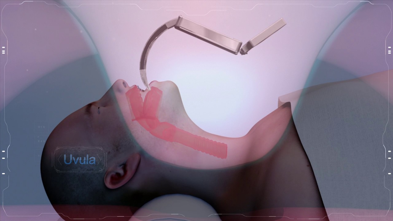 video laryngoscope