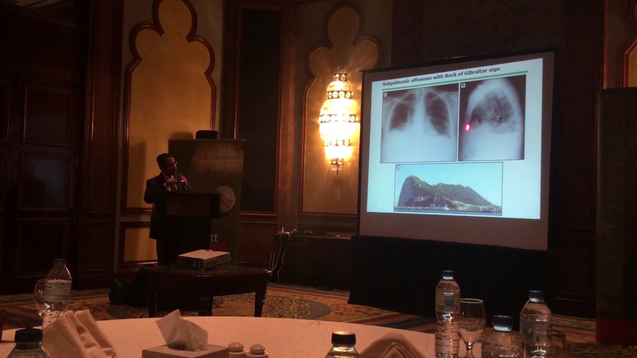 Non Malignant Pleural Effusion 1