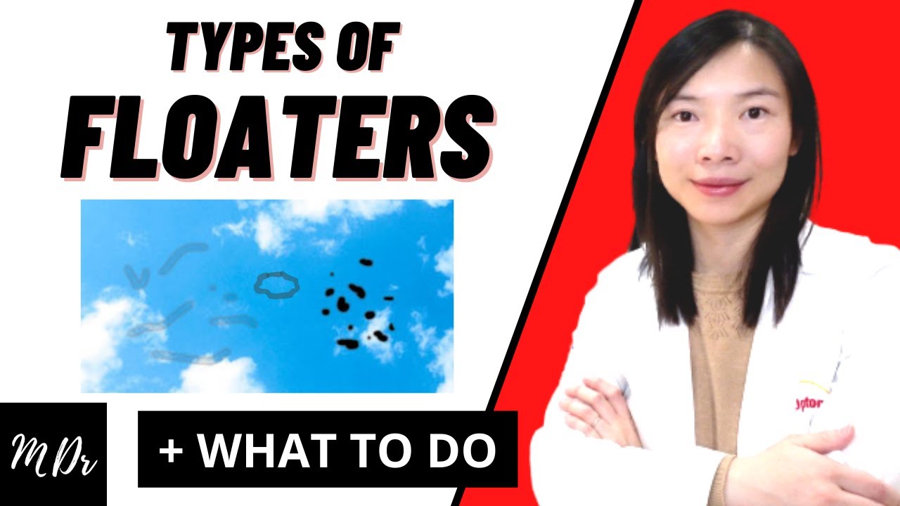 THREE Common Causes of Floaters Explained (MUST Watch!!!)