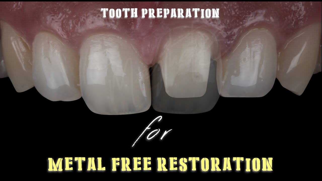 Anterior Tooth Preparation for Metal Free Restoration... Video Demonstration