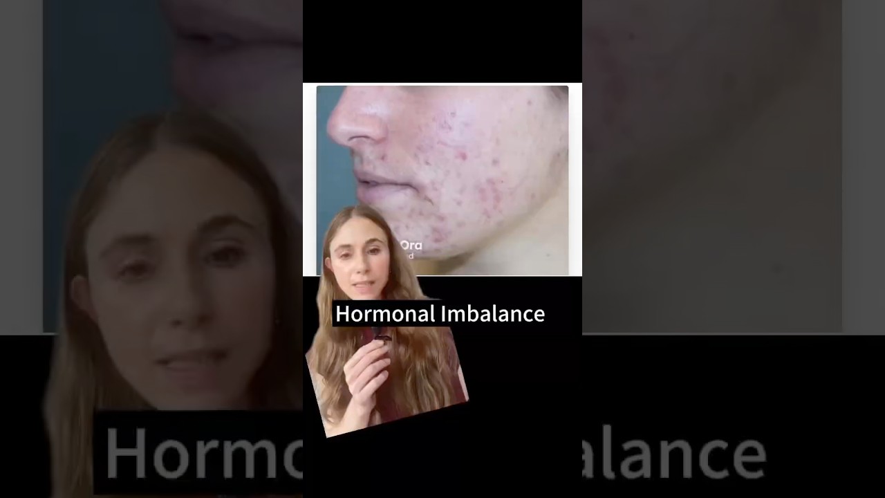 Objawy zaburzeń hormonalnych #dermatolog