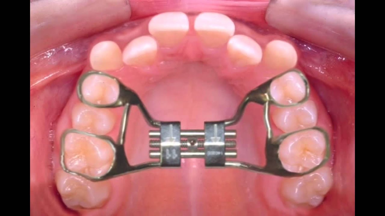 Rapid Palatal Expander