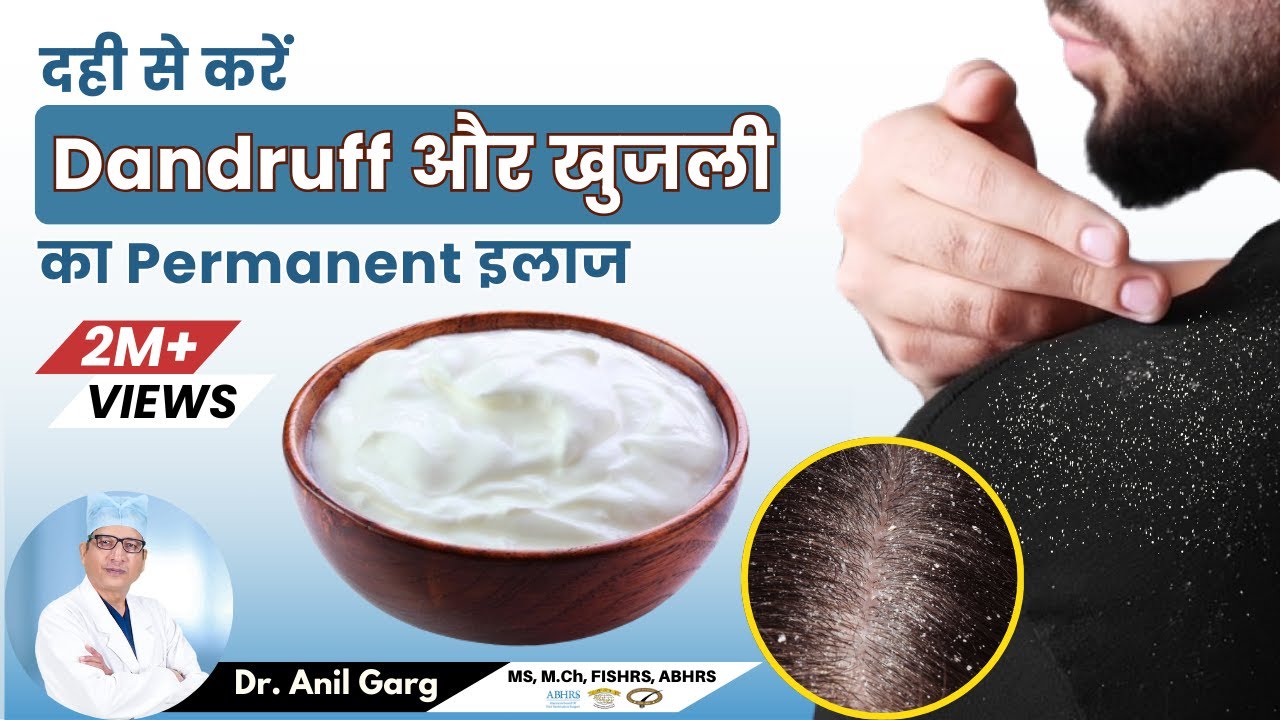 दही से Dandruff कैसे हटाए -  How To Use Dahi For Dandruff | Remove Dandruff