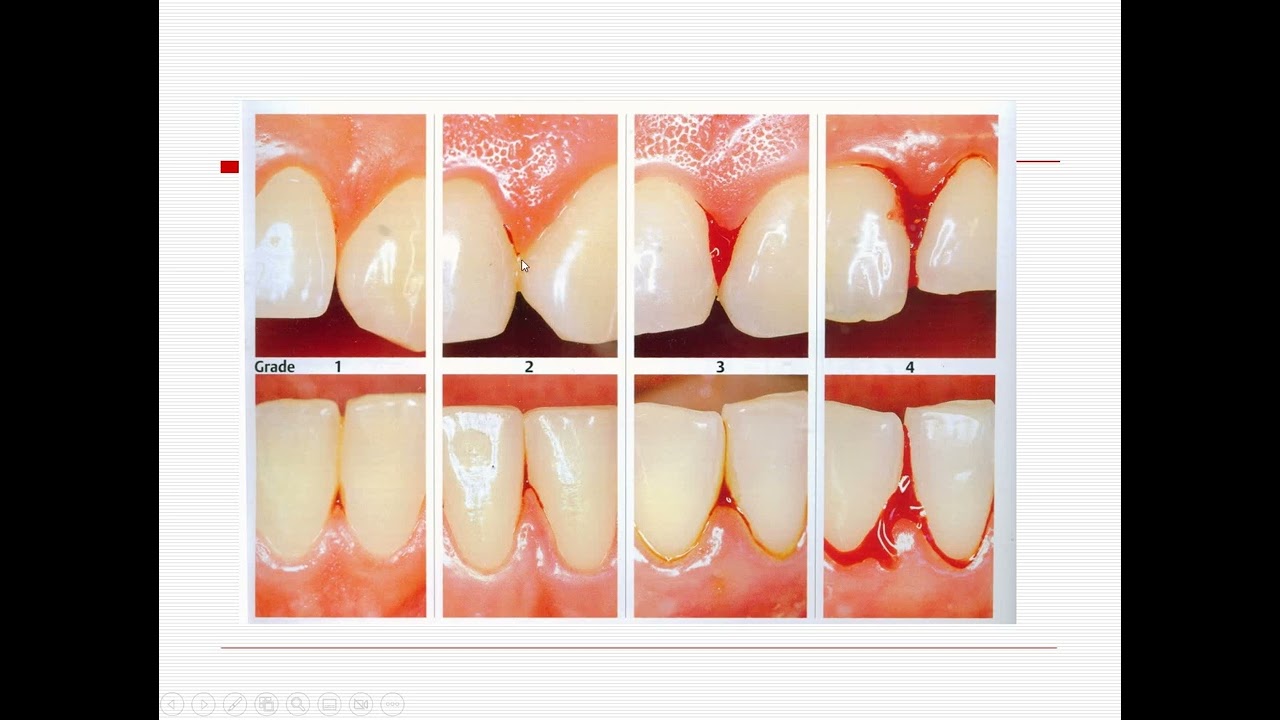 acute gingival conditions