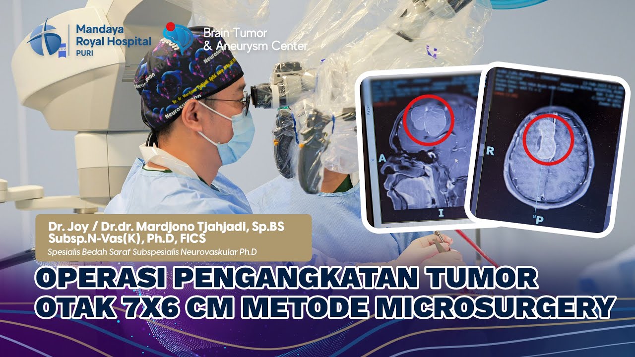 Operasi Pengangkatan Tumor Otak Berukuran 7x6 CM oleh Dr. Joy di Mandaya Royal Hospital Puri