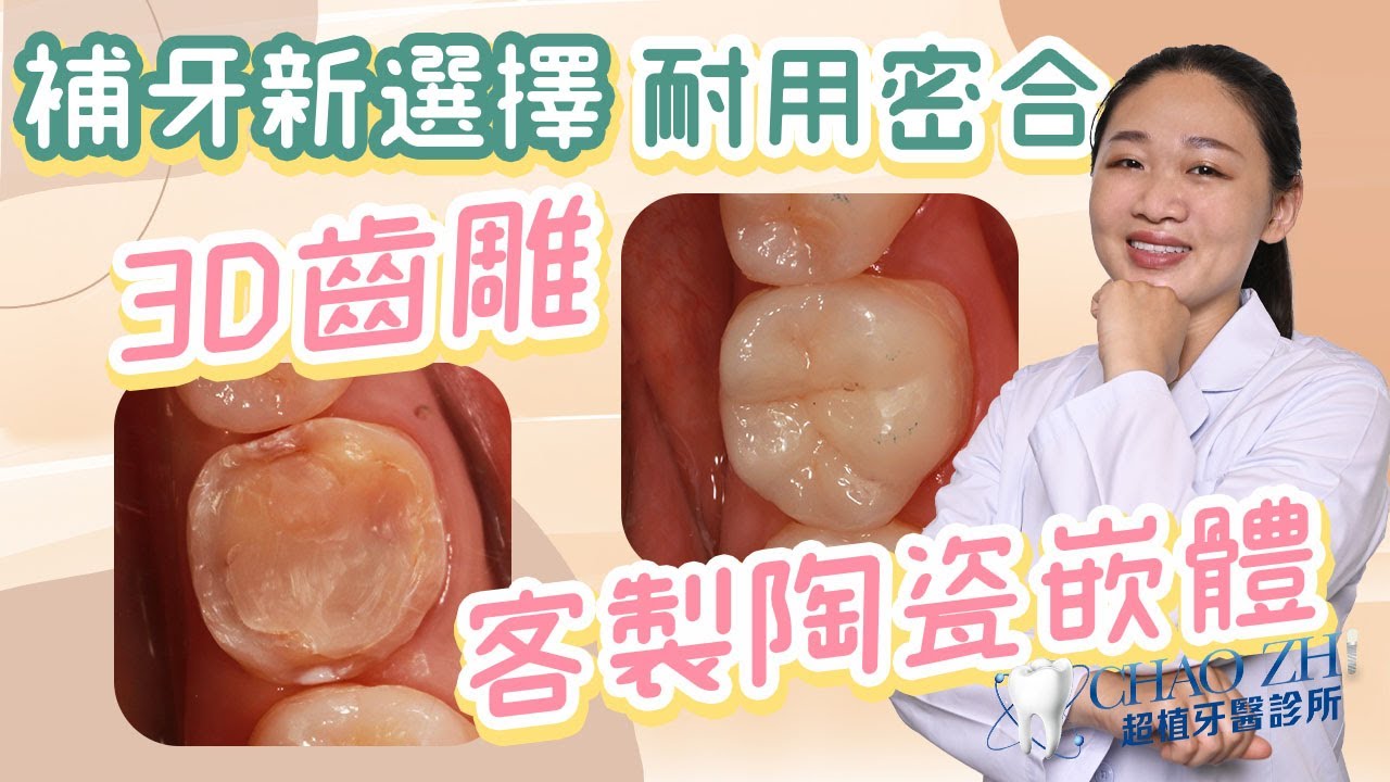 為什麼要做3D齒雕？｜台中牙科陳怡蓉醫師小學堂EP.5 重新打造您的牙齒，不破壞真牙結構｜精緻3D齒雕 #3D齒雕 #台中牙醫