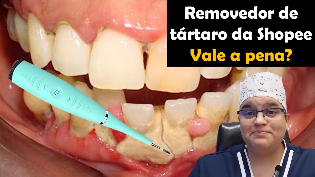 Tira tártaro da Shopee , 5 Coisas que você deve saber antes de comprar!| Master Pride Odontologia |
