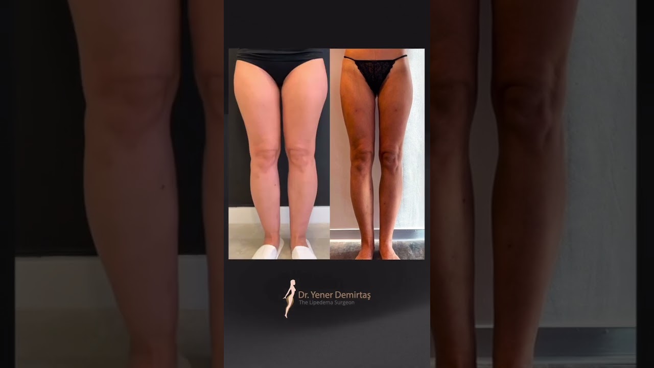 1 Year After VASER Lipo: 7L Fat Gone! 🔥🦵 #LipedemaSurgery