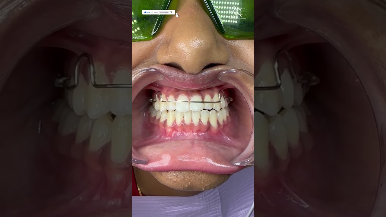 Retainer After Braces | Orthodontic Treatment - #braces #dentalbraces #bracesoff #orthodontics