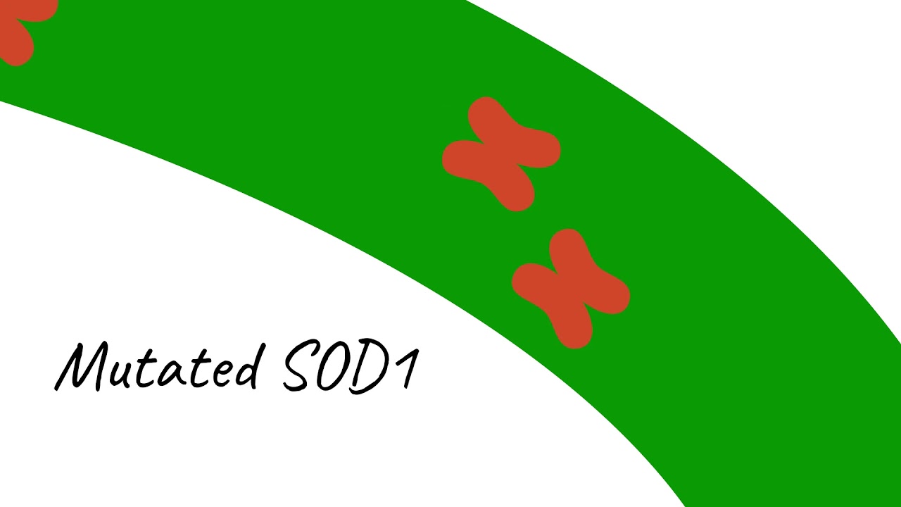 SOD1 silencing as a treatment for ALS